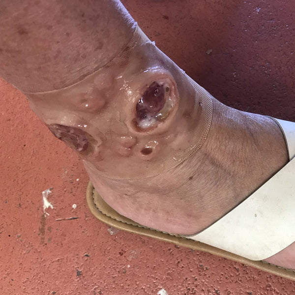 Infected wounds mw020 Ulcers on ankle - MedicFX